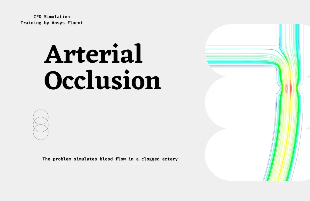 Arterial Occlusion CFD Simulation, ANSYS Fluent Tutorial